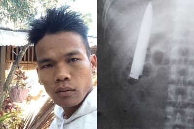 Pria Filipina Ini Gak Tahu Ada Pisau Tertancap di Tubuhnya, Ketahuan saat Medical Check Up Masuk Kerja