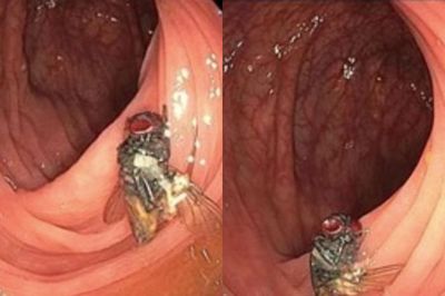Viral Ada Lalat Utuh Ditemukan Dalam Usus Seorang Pria di AS, Ternyata Ini Bukan Kasus Pertama Serangga di Tubuh Manusia