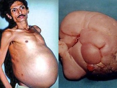 Kisah Petani India yang Hidup Bersama Saudara Kembar di Dalam Tubuhnya Selama 36 Tahun
