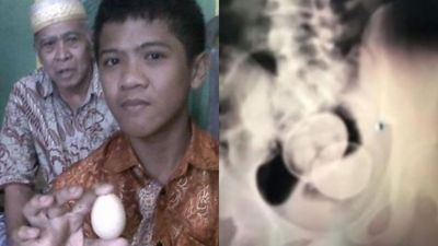 Kisah Remaja Petelur di Gowa dan Fakta Medis di Baliknya, Benarkah Bertelur?
