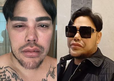 Foto Mata Bengkak hingga Sesak Napas Bikin Geger, Ternyata Ini yang Dialami Ivan Gunawan