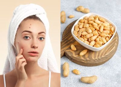 Bener Enggak Sih Kacang Jadi Penyebab Utama Jerawat? Ini Faktanya