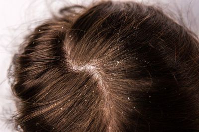 Gak Melulu Ketombe, Bisa Jadi Serpihan Kulit Kepala di Rambut Itu Psoriasis! Berikut 4 Tanda Utama