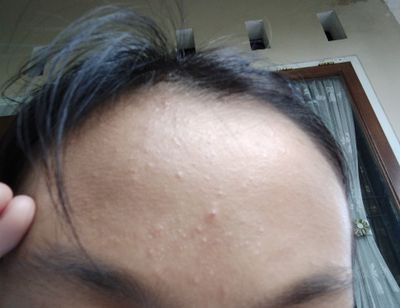 Catat! Inilah Cara Menghilangkan Bruntusan di Jidat Dengan Mudah