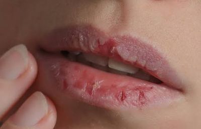 Penyebab Bibir Kering dan Cara Mengatasinya: Hindari Mengelupas Kulit!