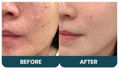 3 Tips Ampuh Hilangkan Flek Hitam di Wajah: Skincare, Peeling hingga Laser