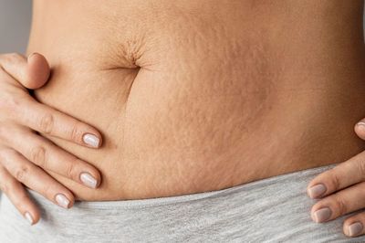 Apa Itu Stretch Mark? Simak Penyebab, Cara Mengatasi dan Tips Mencegahnya