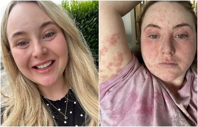 Mau Cantik Malah Jadi Petaka, Cewek Ini Alergi Parah Usai Pakai Veneer hingga Muncul Ruam Merah Sebadan