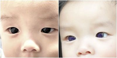 Mata Bayi Ini Berubah dari Coklat Tua ke Biru Cerah Usai Konsumsi Obat COVID-19, Kok Bisa?