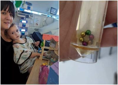 Ngeri! Usus Balita Ini Berlubang Gara-gara Telan 6 Bola Fidget Magnetic, Sampai Muntah Cairan Hijau