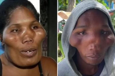 Kisah 5 Bersaudara di Dominika Menderita Penyakit Langka yang Membuat Wajah Mereka Mirip Alien