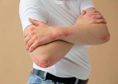 Mengenal Aquagenic Urticaria, Alergi Langka saat Kulit Terpapar Air