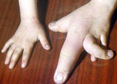 Macrodactyly, Kondisi Langka Terjadinya Pertumbuhan Berlebih di Jari, Kenali Gejala dan Penyebabnya