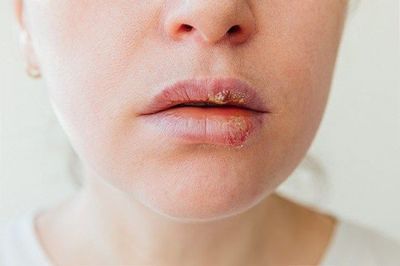 Apakah Penyakit Herpes Berbahaya? Pencegahan dan Pengobatan yang Efektif