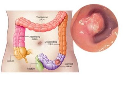 7 Kebiasaan Sehari-hari yang Dapat Menyebabkan Kanker Usus