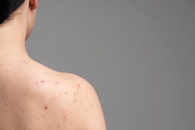 8 Penyebab Jerawat Punggung, Keturunan Hingga Stres