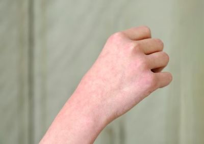 Kulit Kemerahan? Ini 11 Penyebab yang Perlu Kamu Tahu
