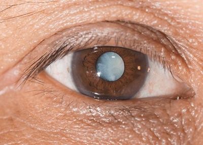 Rahasia Dibalik Manfaat Vitamin B dan Kolin: Senjata Baru Melawan Glaukoma