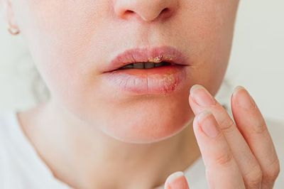 12 Mitos dan Fakta Penyakit Herpes, Salah Satunya Tidak Bisa Memiliki Anak