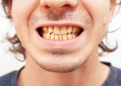 10 Jenis Makanan dan Minuman yang Menyebabkan Gigi Menjadi Kuning