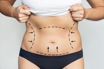9 Hal Penting yang Harus Diketahui Sebelum Sedot Lemak, Ternyata Tidak Menurunkan Berat Badan?