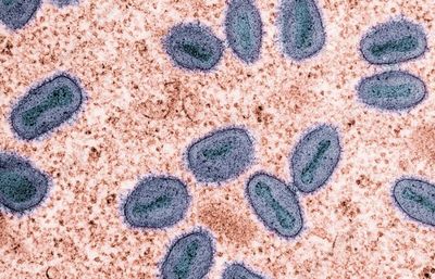 Filipina Deteksi Kasus Virus MPOX Tahun Ini, Belum Diketahui Pasti Jenisnya