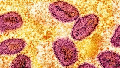 6 Fakta Wabah Virus Mpox yang Kini Sedang Meningkat di Afrika hingga Filipina