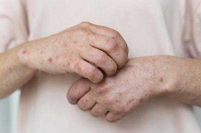 Memahami Kerentanan Mpox: Anak-anak Lebih Berisiko dari Lansia