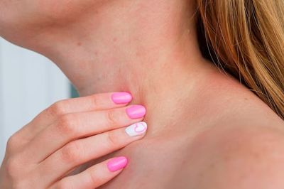 Penyebab dan Cara Mengatasi Jerawat di Leher dengan 7 Obat Alami