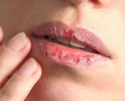 Kenali Dermatillomania, Kondisi Sering Cabuti Kulit yang Dapat Bahayakan Kesehatan