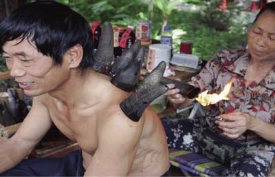 Mengenal Jiaofa, Metode Bekam Tradisional China