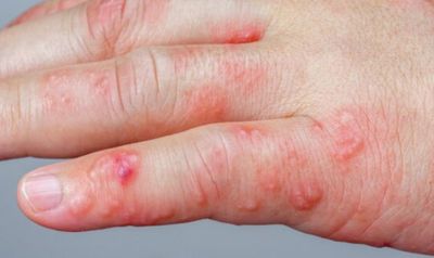 Kenali Pompholyx, Eksim yang Bisa Muncul Akibat Alergi atau Stres