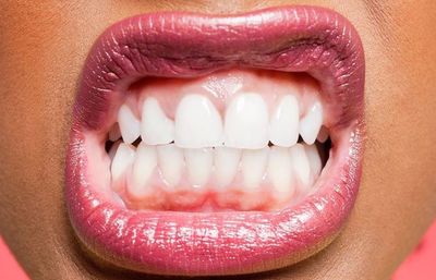 Mengenal Bruxism, Kebiasaan Menggertakkan Gigi saat Tidur yang Bisa Jadi Tanda Stres