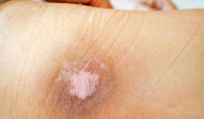 Waspada! Bed Sores Bisa Berujung Infeksi Serius
