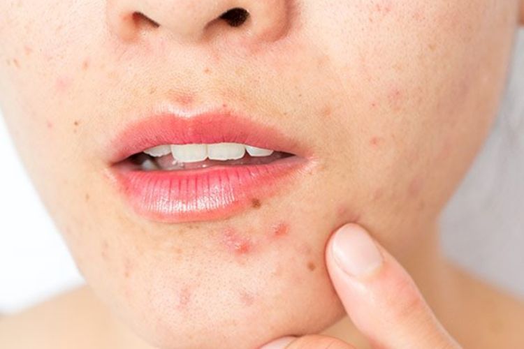 Jangan Asal Pakai! Ini Efek Samping Benzoyl Peroxide yang Sering Diremehkan