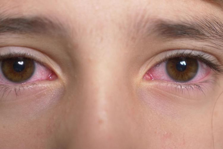 Sering Terpapar Matahari? Waspadai Pterigium yang Bisa Ganggu Penglihatan