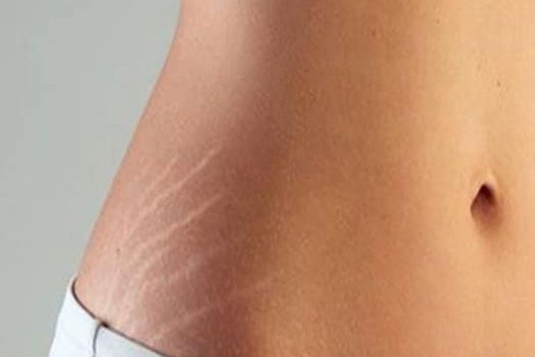 7 Cara Menghilangkan Stretch Mark Secara Alami, Biar Kulit Mulus Kembali!