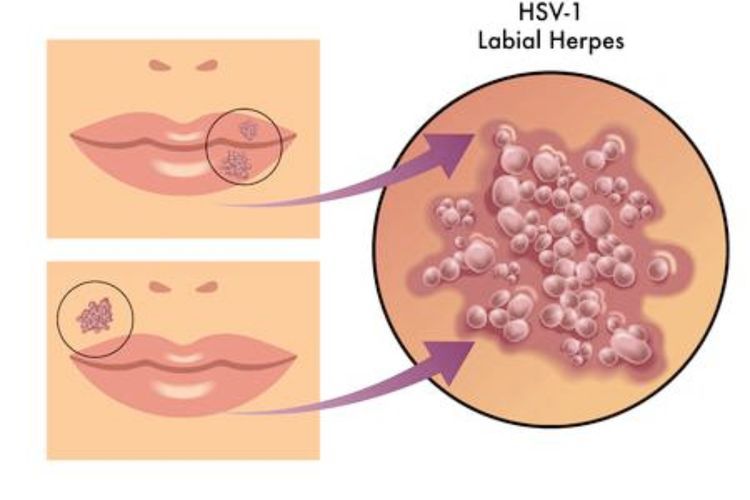 Herpes: Gejala, Penyebab dan Pengobatannya