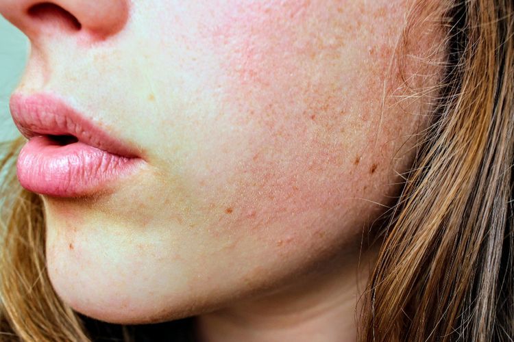 Jerawat hingga Penuaan Dini, Ini Tanda Hormonmu Tidak Seimbang