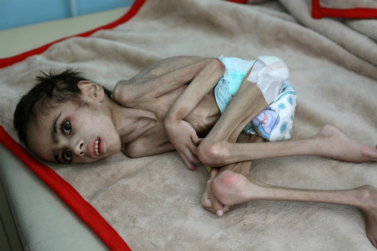 Bocah Ini Cuma Punya Berat 7 Kg Akibat Kelaparan, Keluarga Tak Mampu Bayar Biaya Peratawan