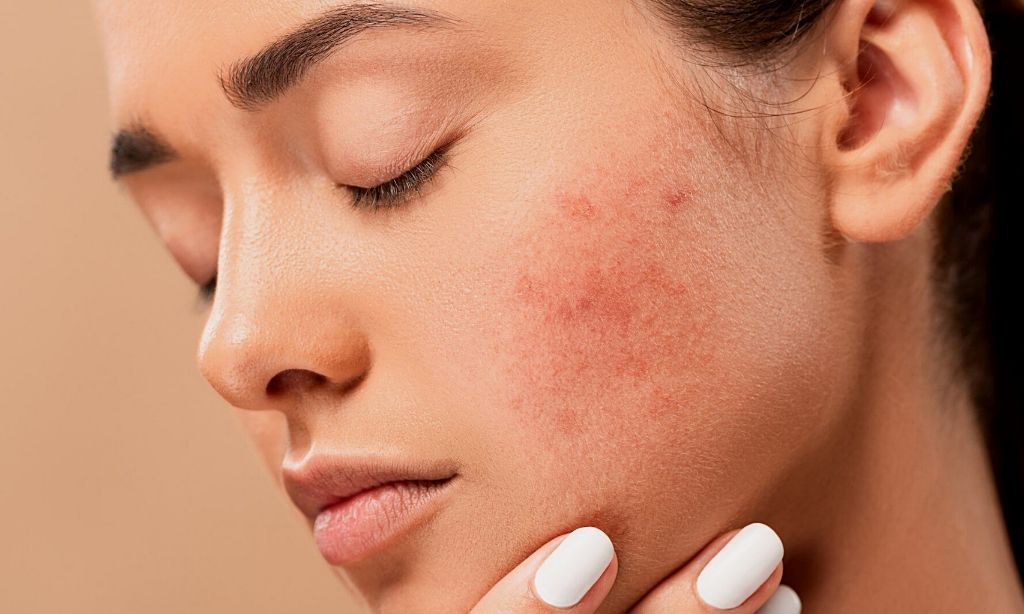 Banyak Dipakai Beauty Influencer, Amankah Cream Glycore untuk Wajah?
