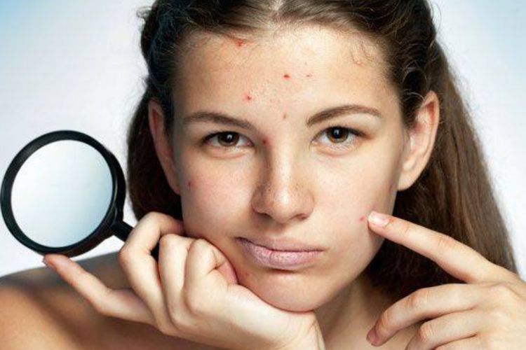 Benarkah Tea Tree Oil Ampuh untuk Mengatasi Jerawat? Temukan Jawabannya Disini!