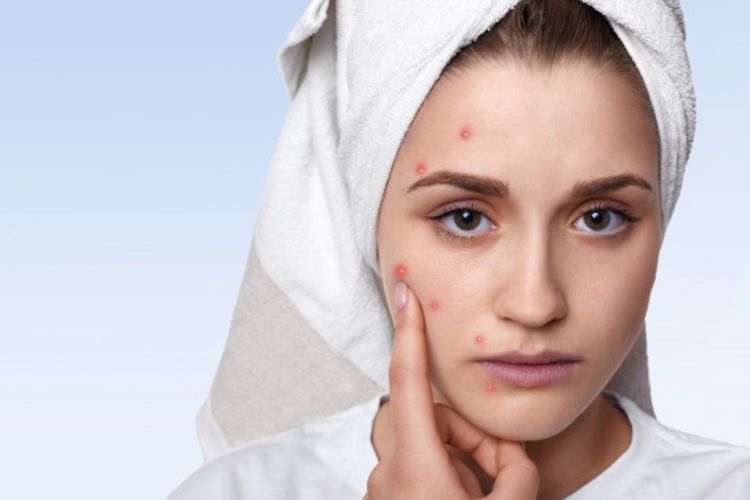 Niat Menghilangkan Jerawat, Wajah Malah Bengkak dan Susah Nafas? Reaksi Benzoyl Peroxide Ini Bisa Bahaya!