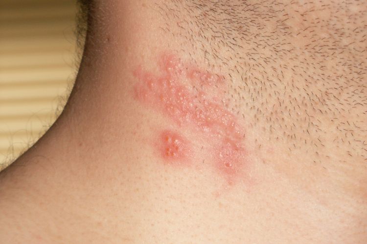Obat Herpes Zoster di Kulit yang Ampuh dari Bahan Alami
