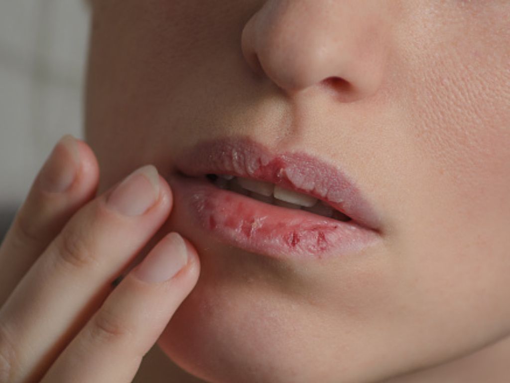 Tips Atasi Bibir Kering dan Pecah-pecah Selama Puasa: Konsumsi Ini Saat Sahur dan Berbuka!