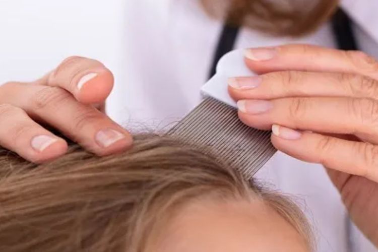 Waspada! 5 Kebiasaan Sepele Ini Jadi Penyebab Rambut Penuh Kutu