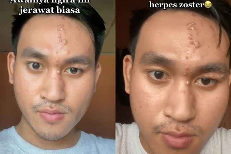 Dikira Jerawat, Benjolan di Wajah Pria Ini Ternyata Disebabkan Herpes Zoster, Apa Itu?