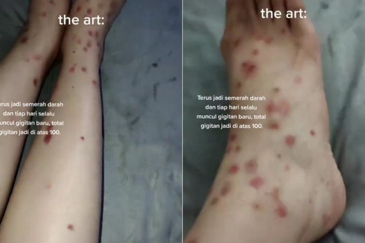 Viral Wanita Alami Ruam Merah di Kaki Usai Digigit Kutu Kucing, Ini Dampak Gigitannya