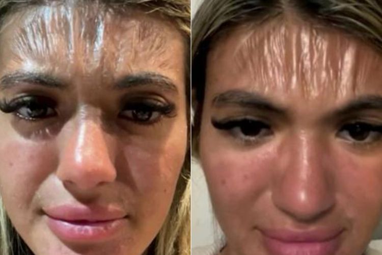 Berjemur Tak Pakai Sunscreen, Dahi Wanita Ini Berubah Jadi Plastik, Ini Bahayanya