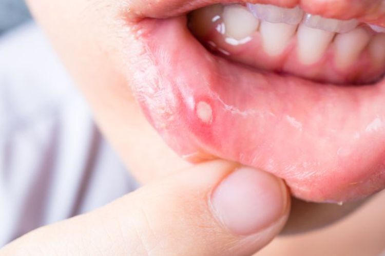 Wajib Tahu! 8 Makanan dan Minuman Ini Dapat Bantu Sariawan Cepat Sembuh